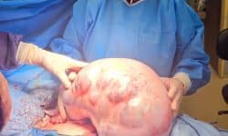 خارج‌ کردن  توده ۱۰ کیلویی از شکم بیمار در کرج