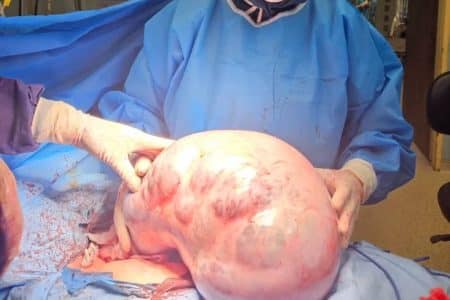 خارج‌ کردن  توده ۱۰ کیلویی از شکم بیمار در کرج
